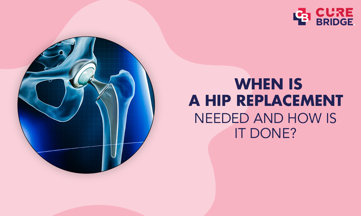 When is a Hip Replacement Needed and How is it Done?