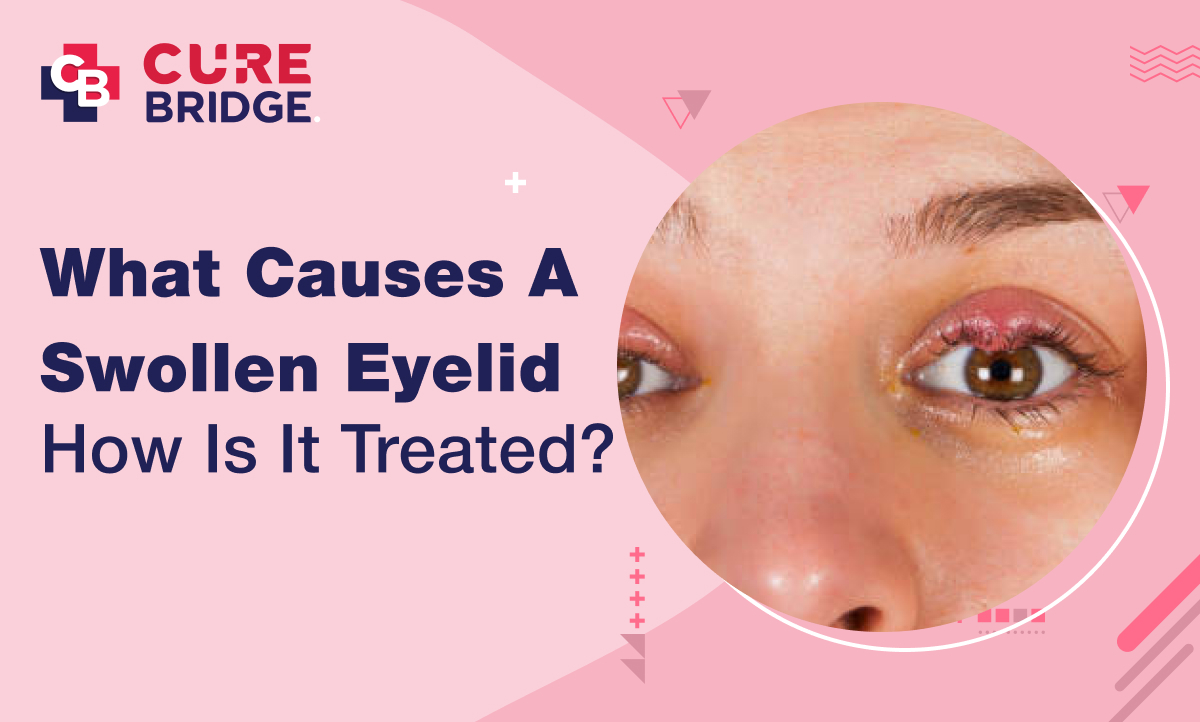 What Causes a Swollen Eyelid, and How Is It Treated?