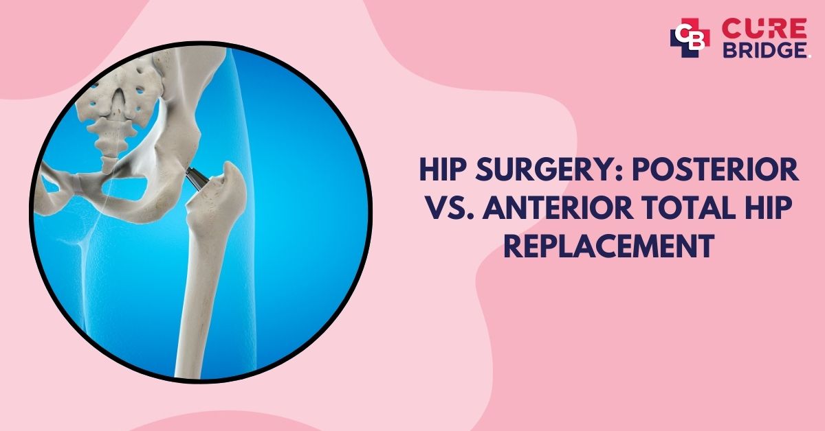 Hip Surgery: Posterior vs. Anterior Total Hip Replacement