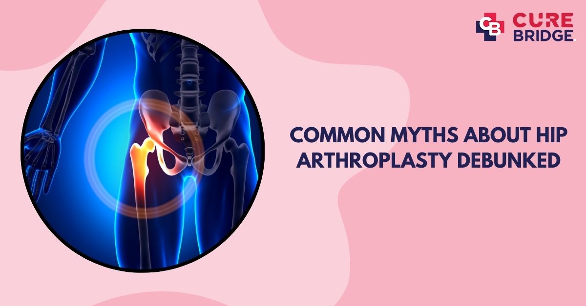 Common Myths About Hip Arthroplasty Debunked