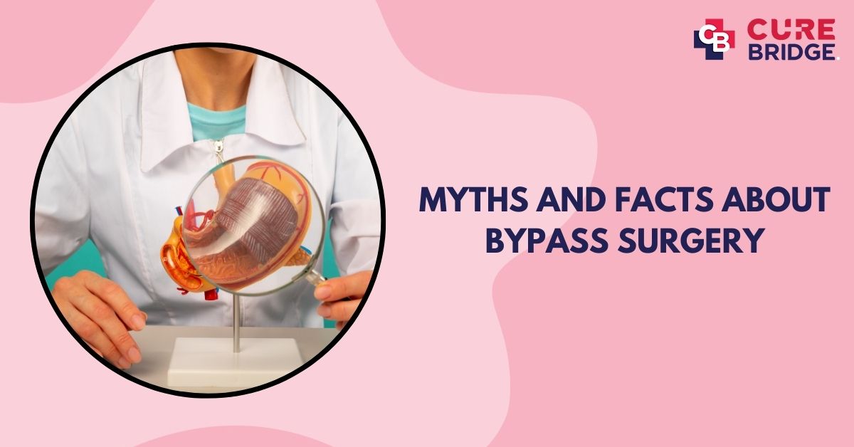 Myths and Facts About Bypass Surgery