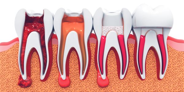 Root Canal Treatment