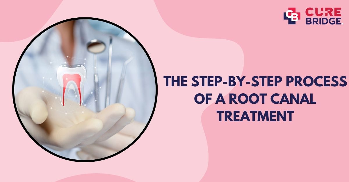 The Step-by-Step Process of a Root Canal Treatment