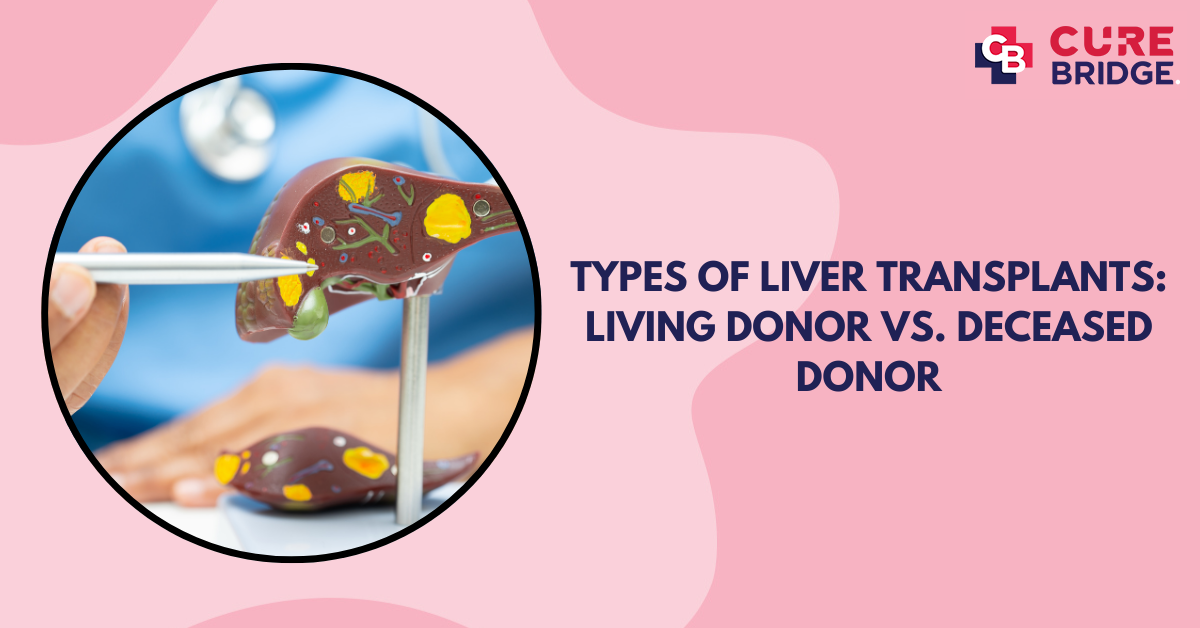 Types of Liver Transplants: Living Donor vs. Deceased Donor